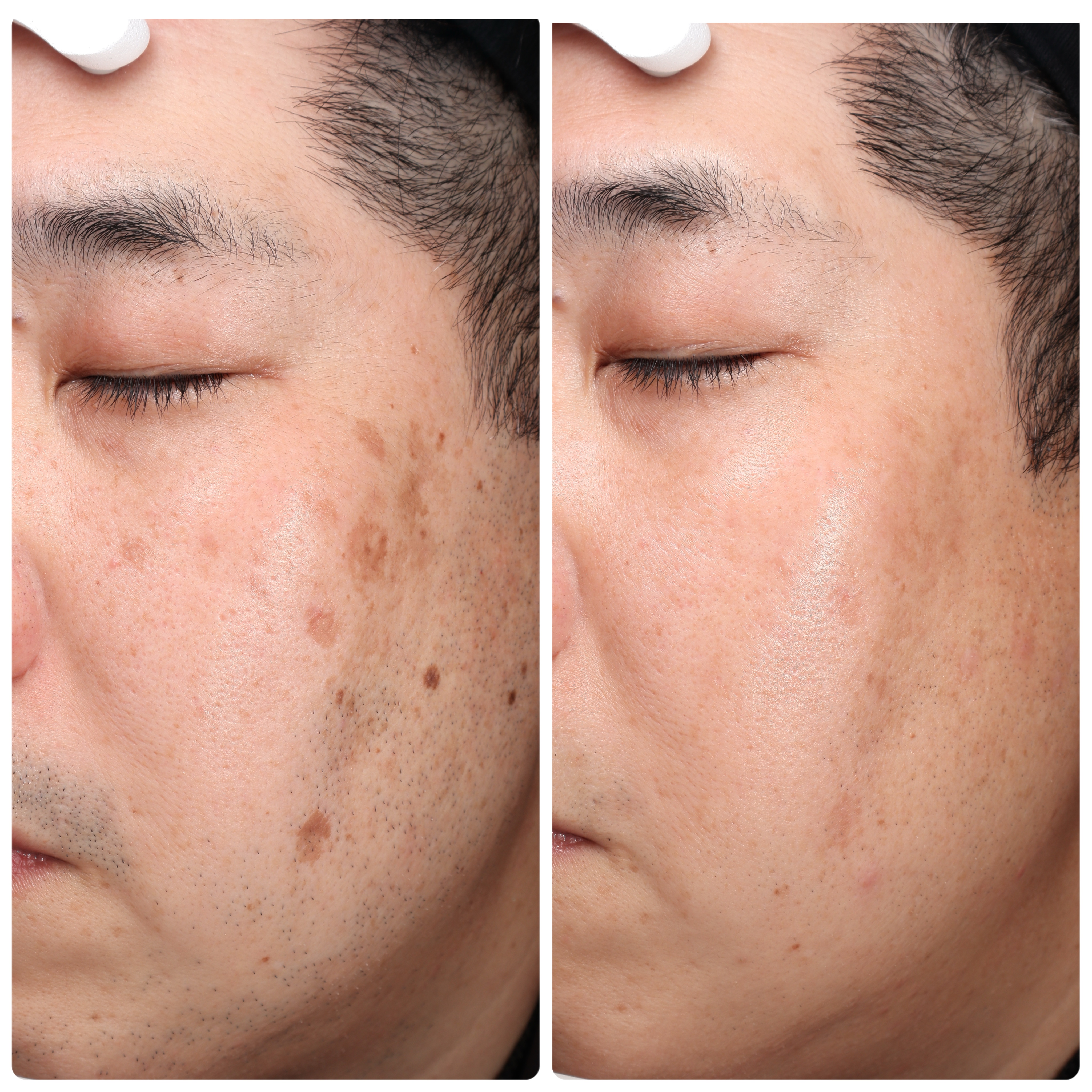 シミとり、ホクロ取り、顔全体のアンチエイジング | 小柳院長ブログ