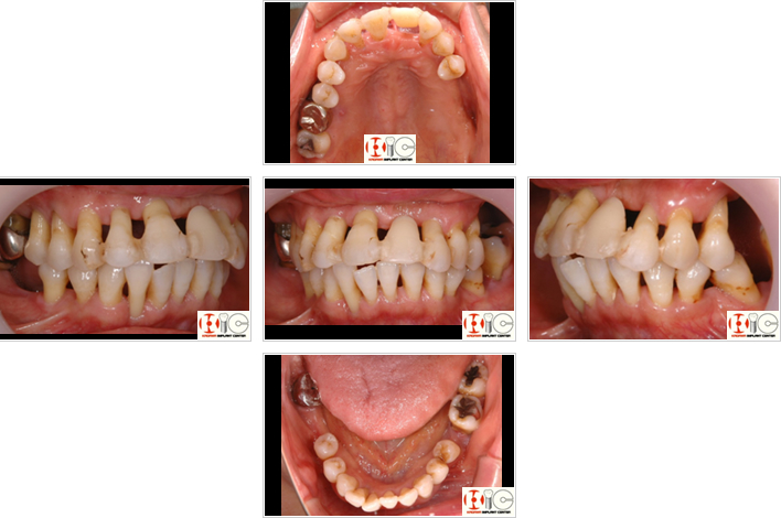 重度慢性歯周病患者における抜歯即時負荷インプラント < 学会講演代表