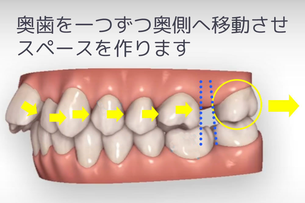 さいたま市北区宮原駅1分の矯正歯科｜矯正歯科認定医ならみずき歯科