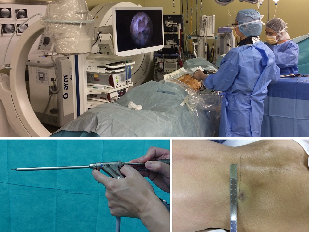 診療科・部門｜整形外科-脊椎・脊髄外科｜脊椎内視鏡手術について