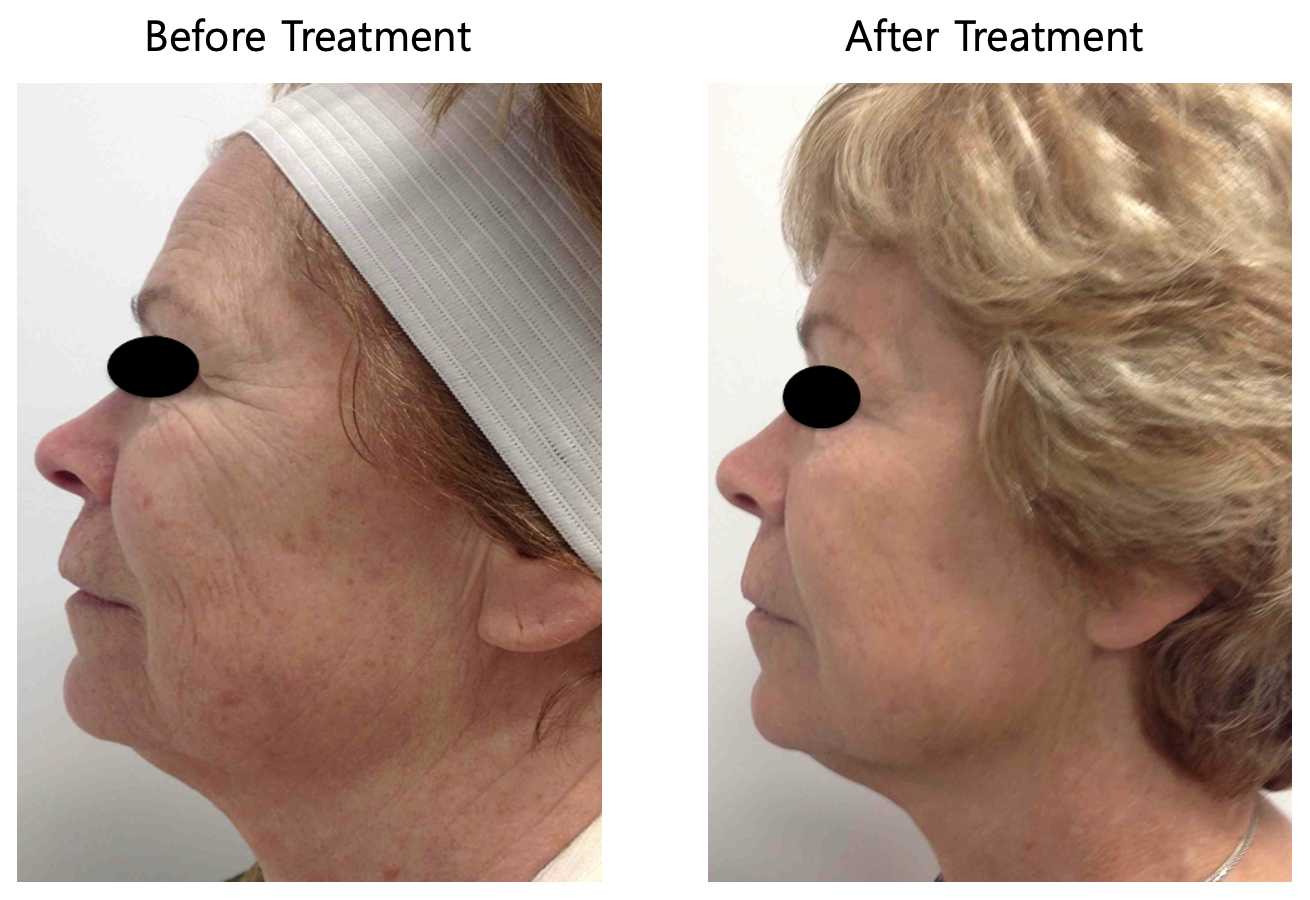 美肌フラクショナルRF・コラーゲンリフトアップ | 佐々木皮膚科