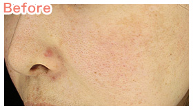 エレクトロポレーション | 自由が丘ロジエクリニック