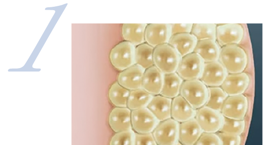 最新脂肪冷却痩身マシン LUMIX lipocool®(ルミクス リポクール)［大