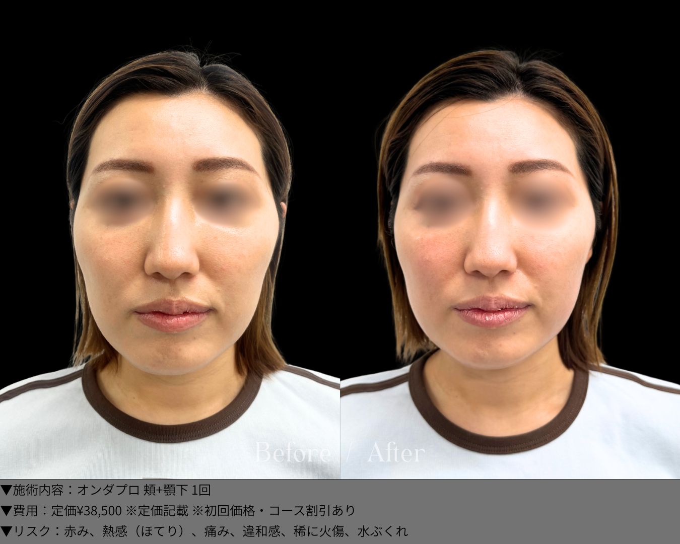 オンダリフトとは？ダウンタイム無しで高い脂肪減少効果_大阪梅田駅3分